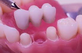 Dental bridges at Om Sai Ram Dental Clinic